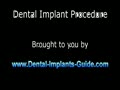 Dental Implant Procedure 